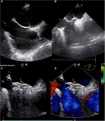 Only transesophageal echocardiography guided patent foramen ovale closure: A single-center experience